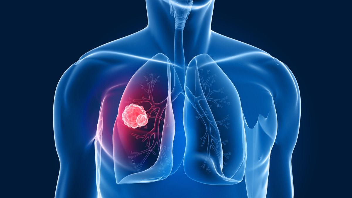 Kanker Paru